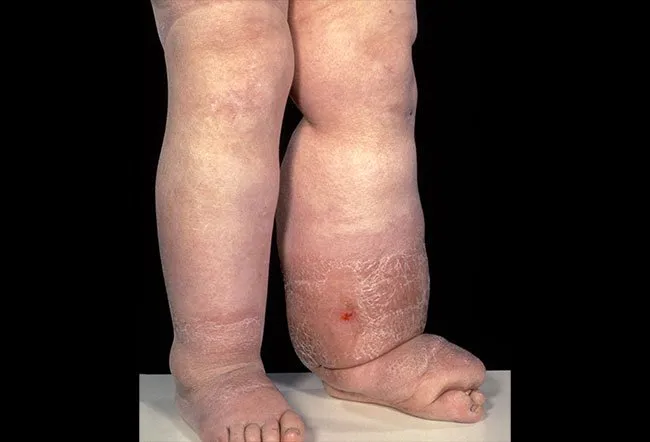 Lymphedema