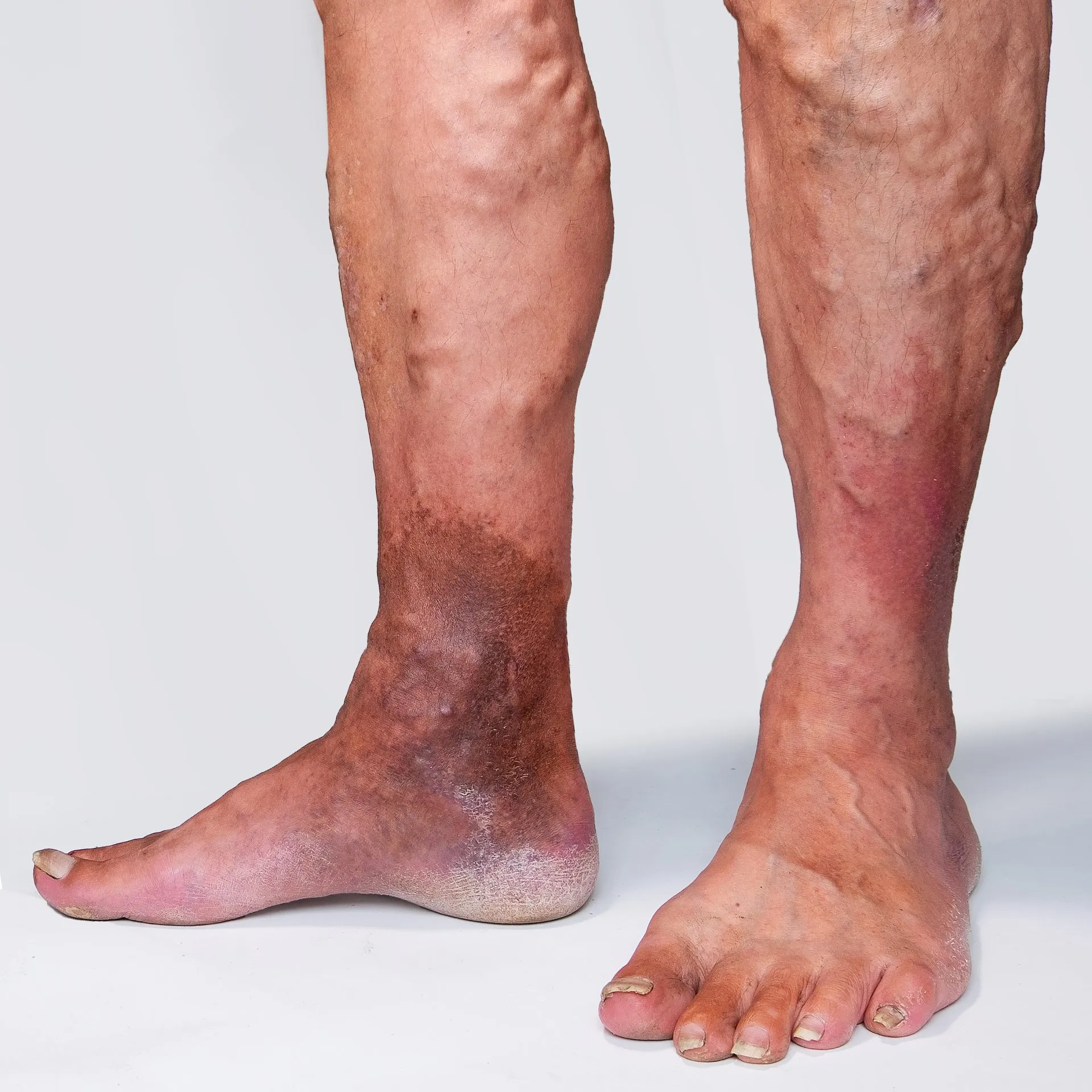 Venous Insufficiency